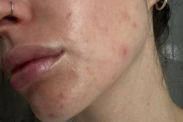 Side of person's face with an annoying amount of acne